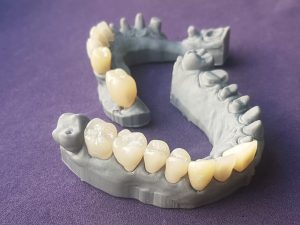 Modelo e dentes provisórios feitos através da impressão 3D